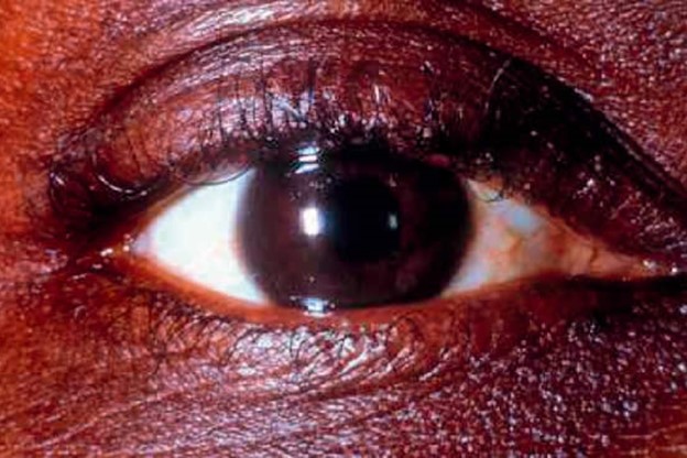 Eye showing signs of glaucoma